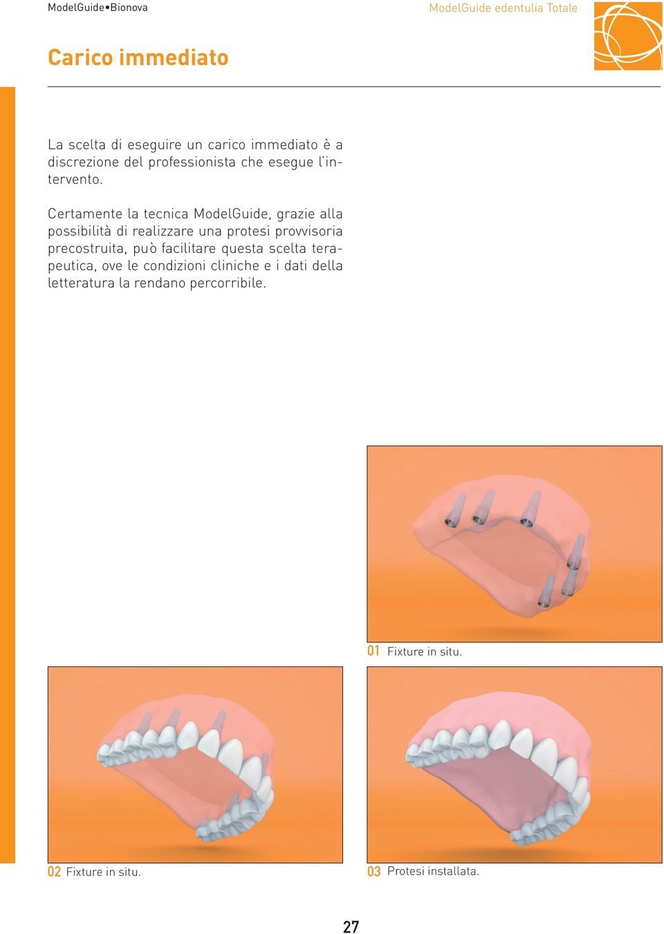 Certamente la tecnica ModelGuide, grazie alla possibilità di realizzare una protesi provvisoria