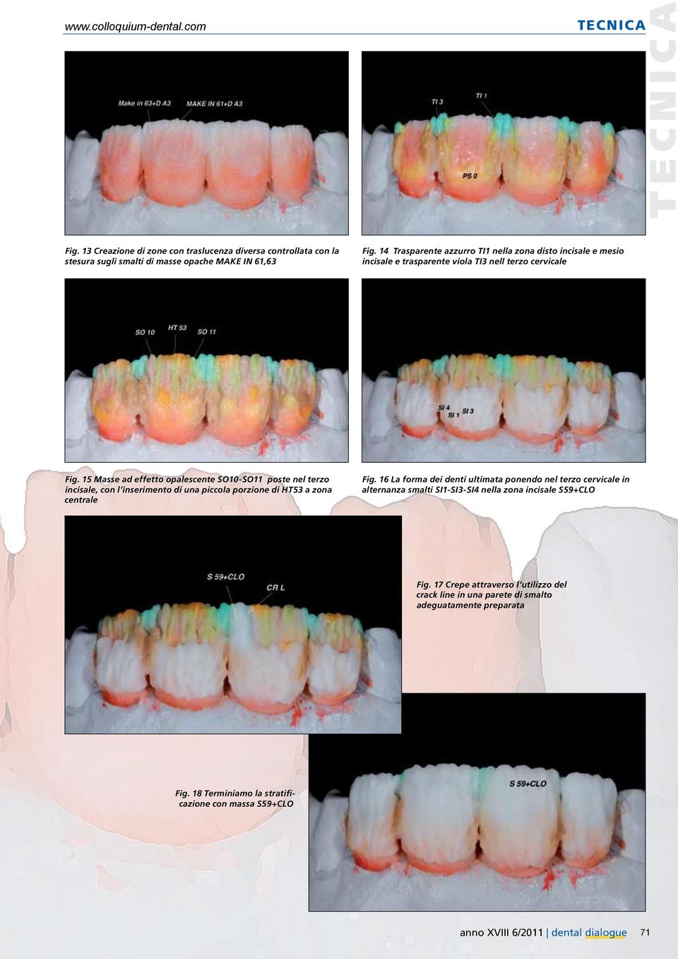 15 Masse ad effetto opalescente SO10-SO11 poste nel terzo incisale, con l inserimento di una piccola porzione di HT53 a zona centrale Fig.