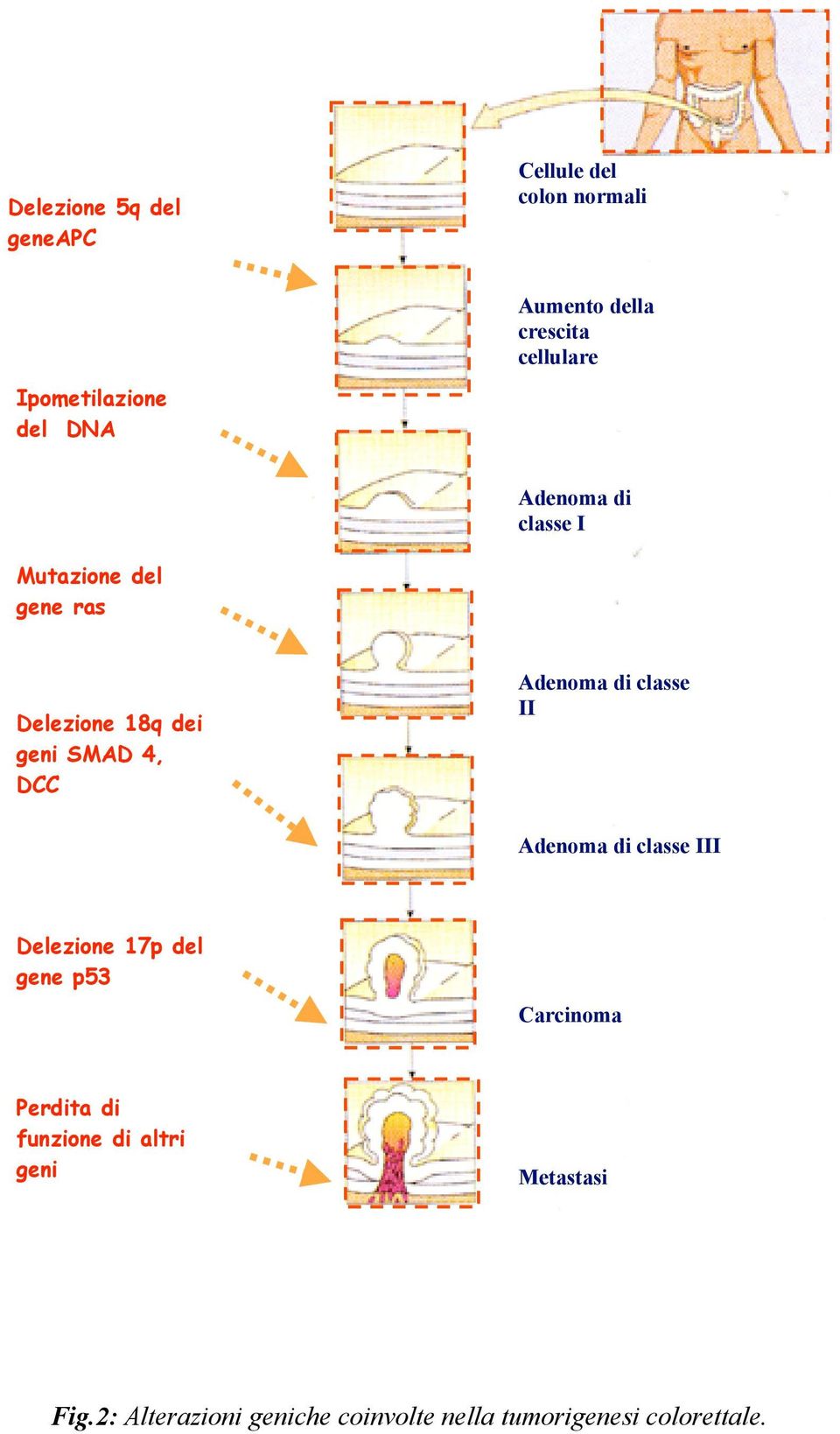 4, DCC Adenoma di classe II Adenoma di classe III Delezione 17p del gene p53 Carcinoma Perdita