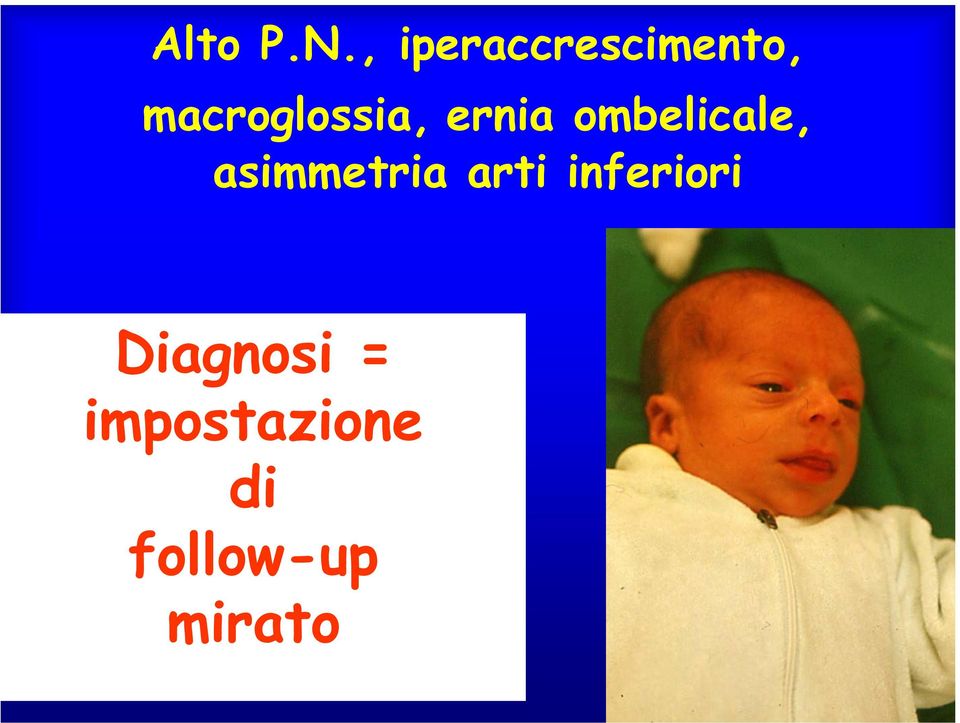 macroglossia, ernia ombelicale,