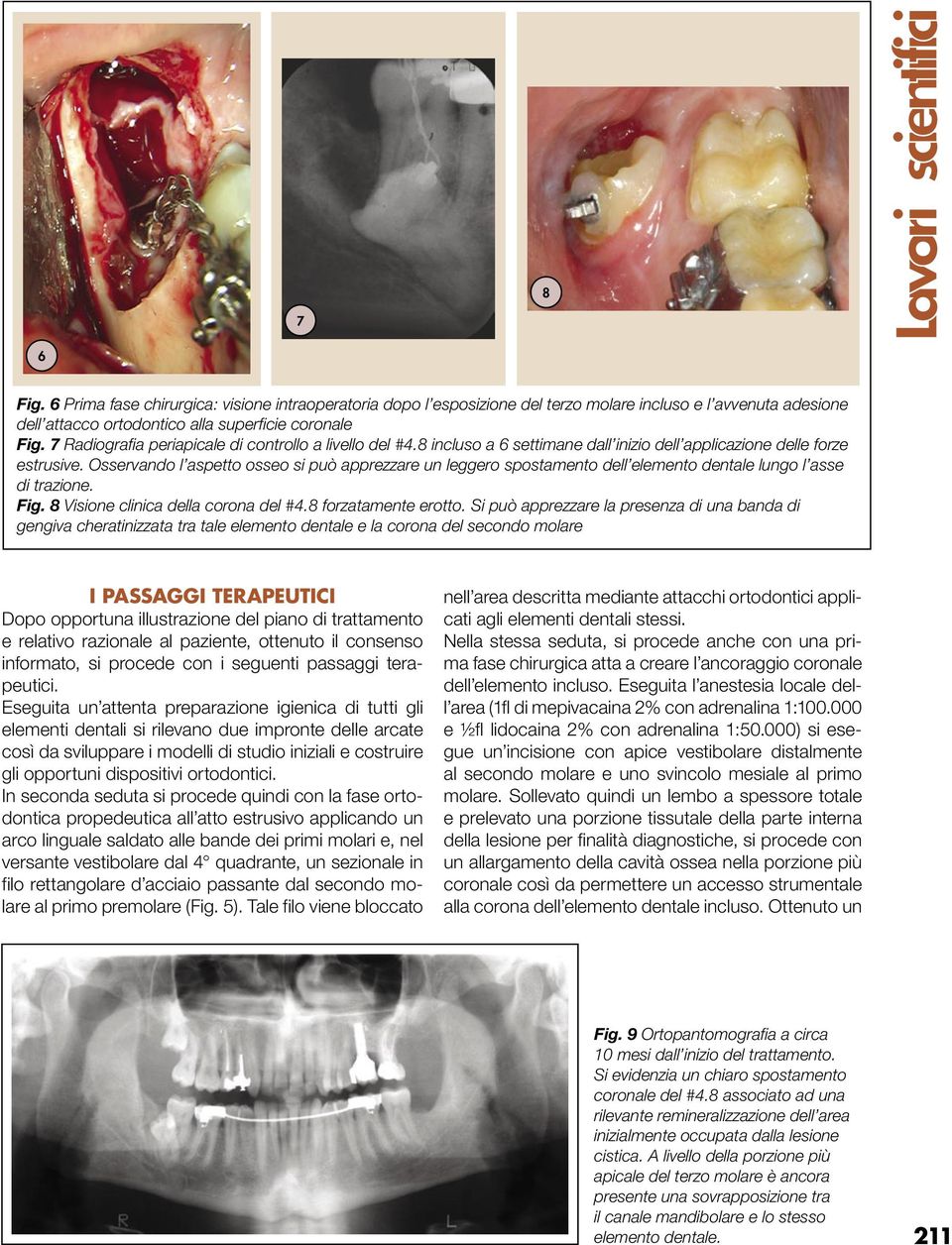 Osservando l aspetto osseo si può apprezzare un leggero spostamento dell elemento dentale lungo l asse di trazione. Fig. 8 Visione clinica della corona del #4.8 forzatamente erotto.