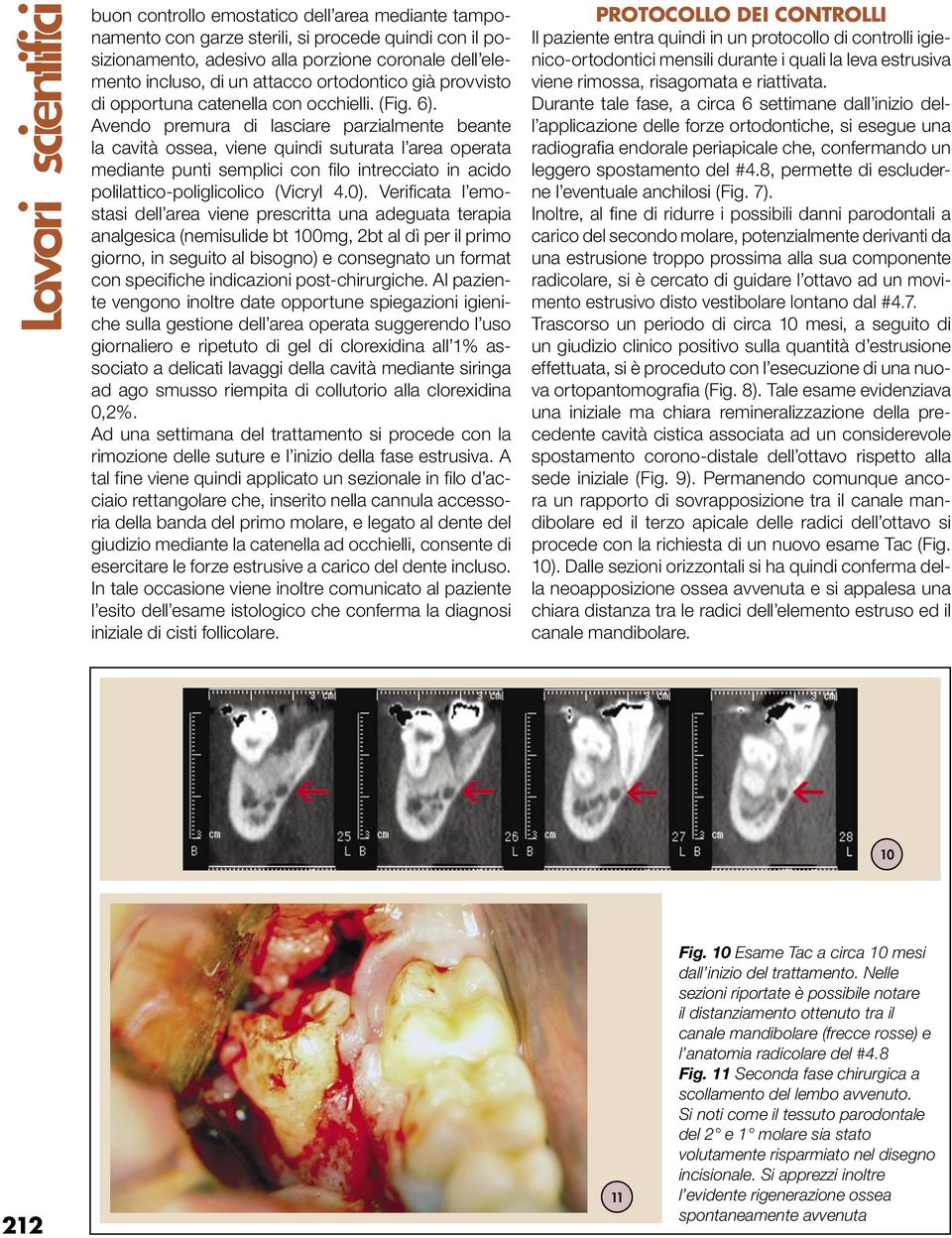 Avendo premura di lasciare parzialmente beante la cavità ossea, viene quindi suturata l area operata mediante punti semplici con filo intrecciato in acido polilattico-poliglicolico (Vicryl 4.0).