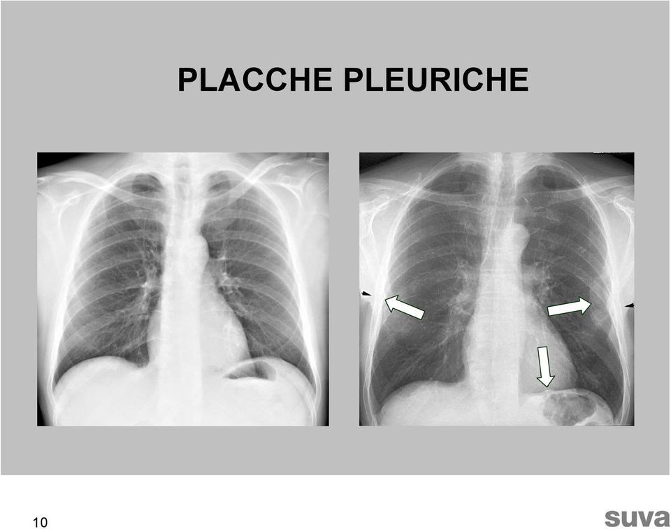 PLEURICHE