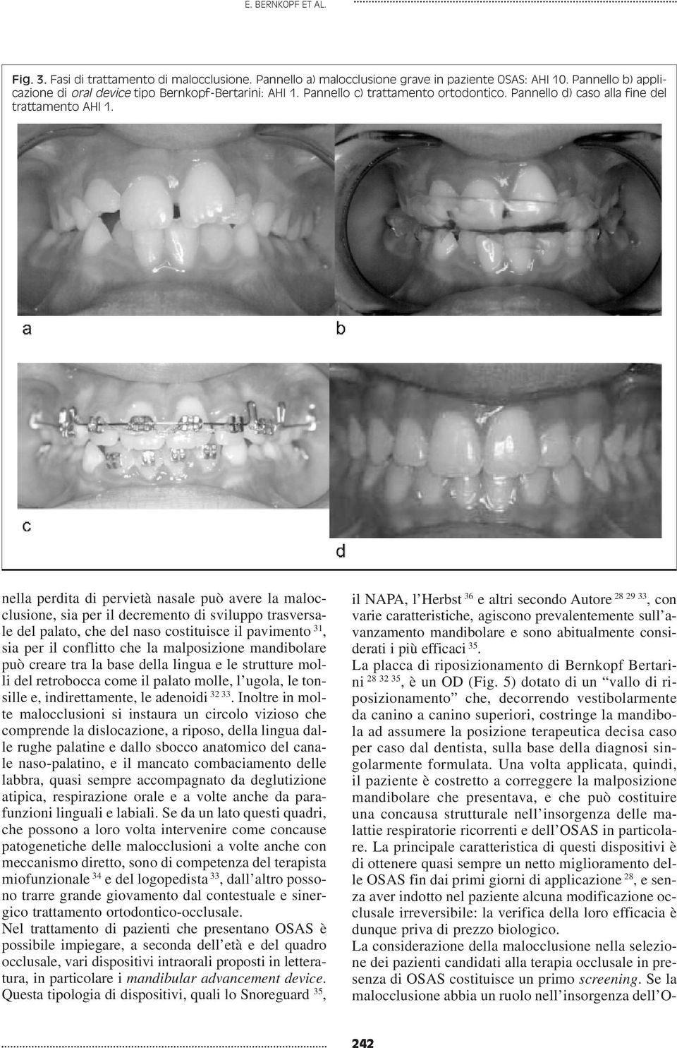 nella perdita di pervietà nasale può avere la malocclusione, sia per il decremento di sviluppo trasversale del palato, che del naso costituisce il pavimento 31, sia per il conflitto che la