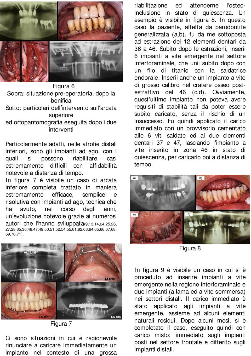 In figura 7 è visibile un caso di arcata inferiore completa trattato in maniera estremamente efficace, semplice e risolutiva con impianti ad ago, tecnica che ha avuto, nel corso degli anni, un