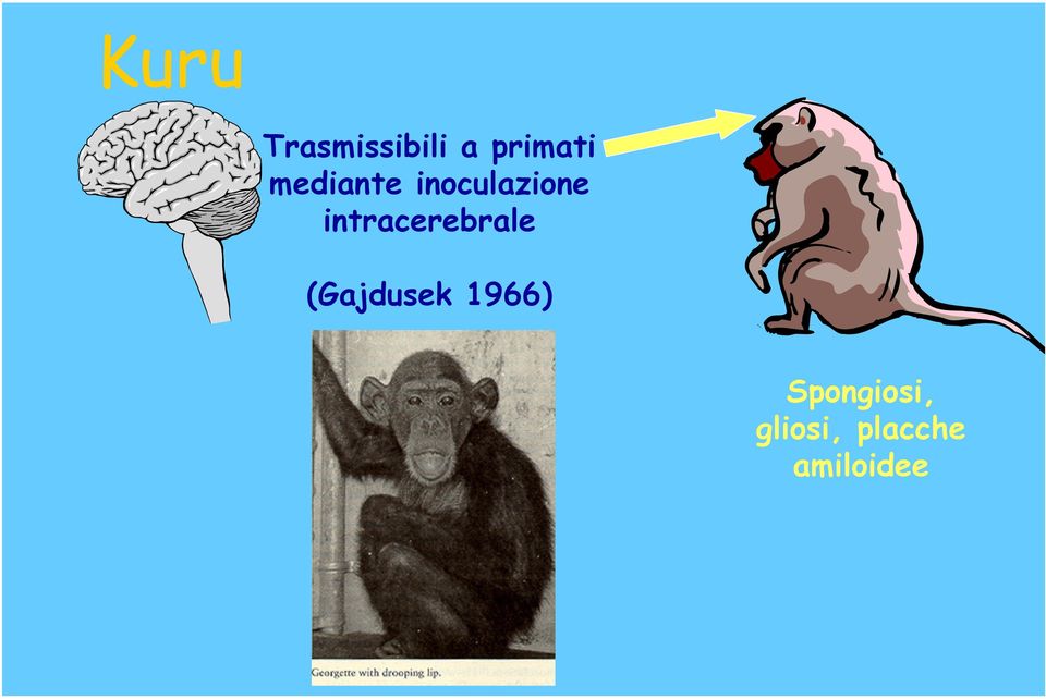 intracerebrale (Gajdusek