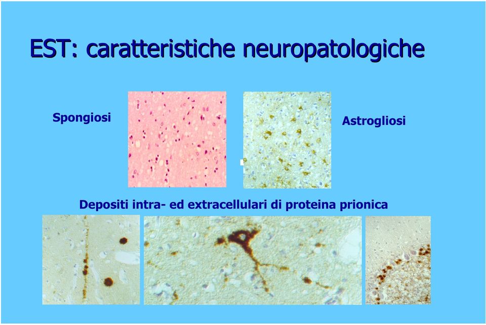 Astrogliosi Depositi intra-