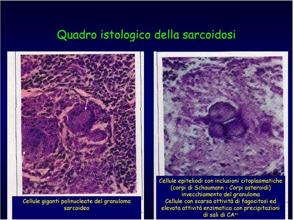 Schaumann - Corpi asteroidi) invecchiamento del granuloma Cellule con scarsa