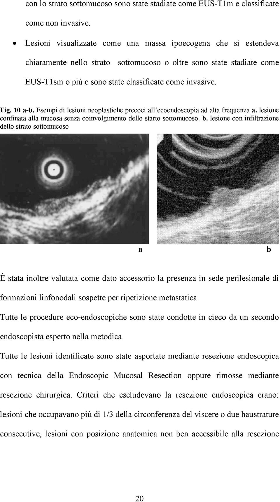 10 a-b. Esempi di lesioni neoplastiche precoci all ecoendoscopia ad alta frequenza a. lesione confinata alla mucosa senza coinvolgimento dello starto sottomucoso. b.