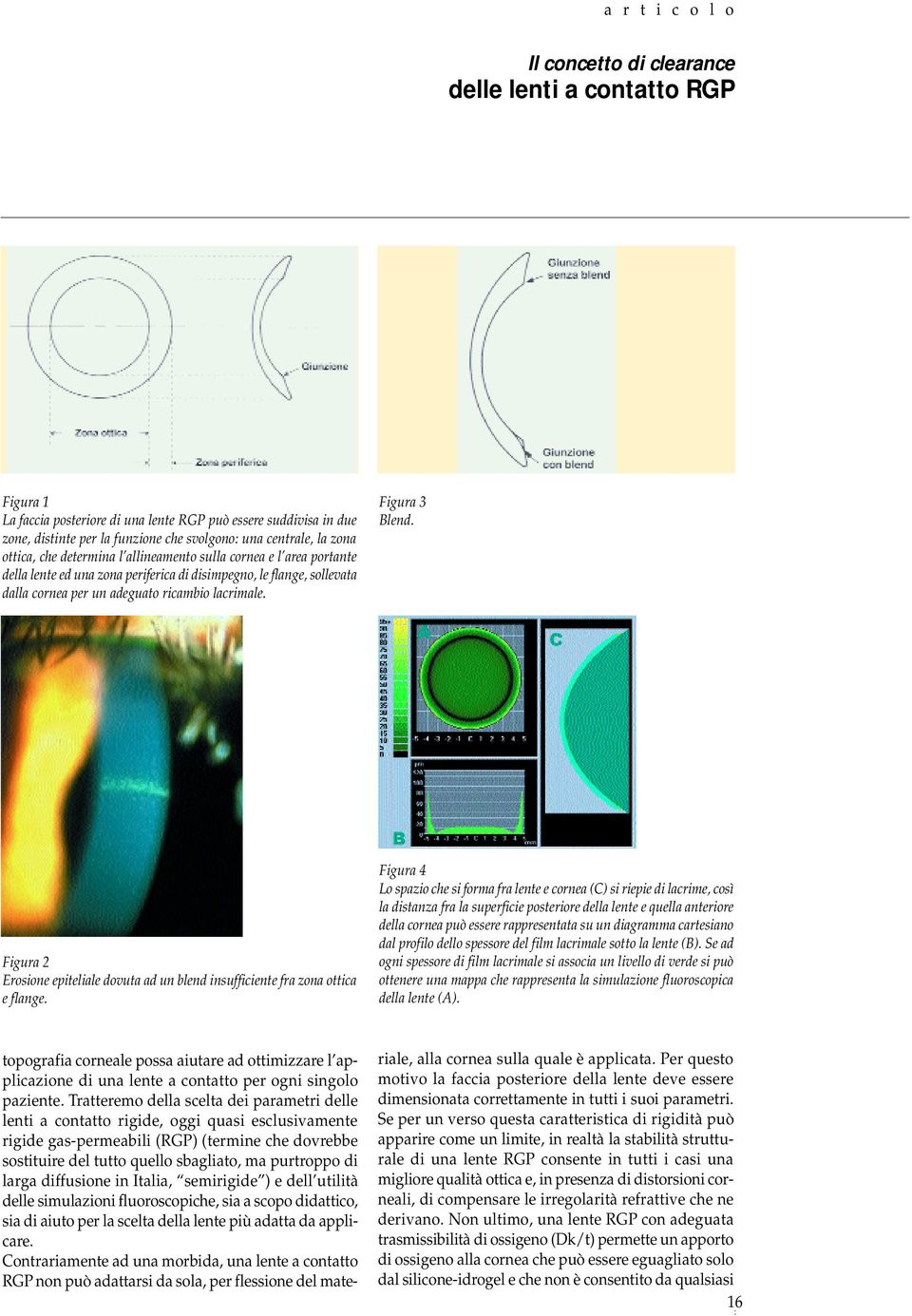 Figura 2 Erosione epiteliale dovuta ad un blend insufficiente fra zona ottica e flange.