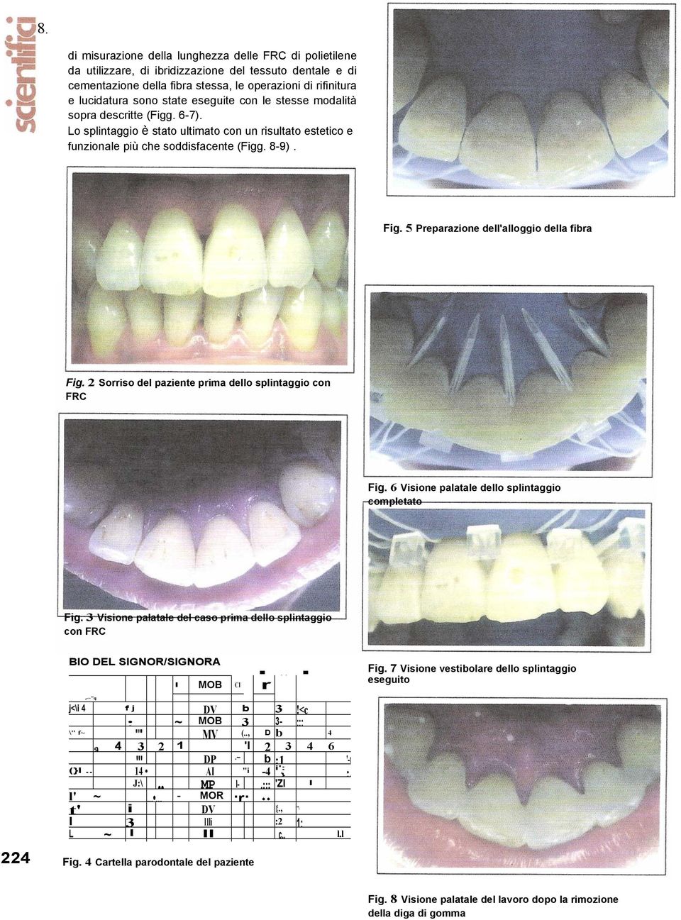 5 Preparazione dell'alloggio della fibra Fig. 2 Sorriso del paziente prima dello splintaggio con FRC Fig. 6 Visione palatale dello splintaggio completato Fig.