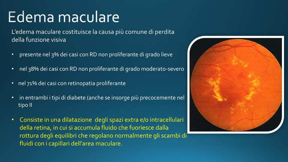 diabete (anche se insorge più precocemente nel tipo II Consiste in una dilatazione degli spazi extra e/o intracellulari della retina, in cui