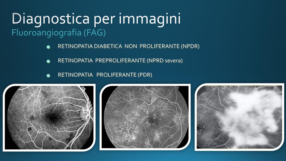 RETINOPATIA PREPROLIFERANTE (NPRD