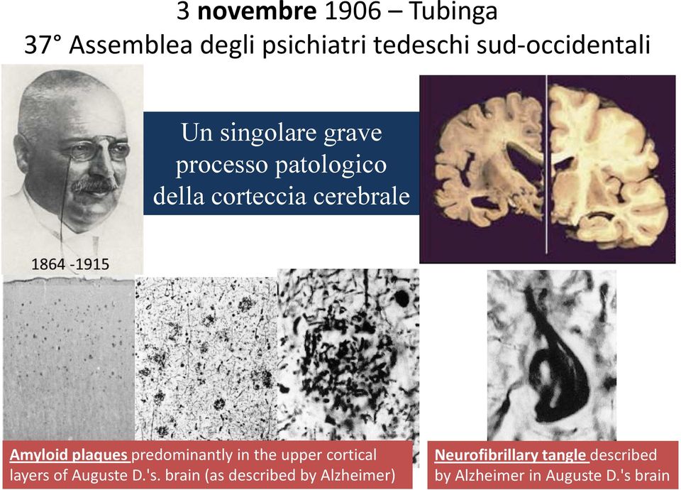 plaques predominantly in the upper cortical layers of Auguste D.'s.