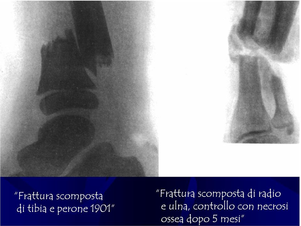 scomposta di radio e ulna,