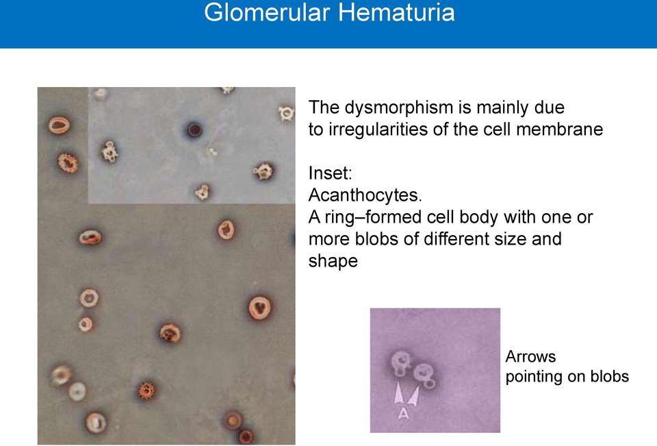 Acanthocytes.