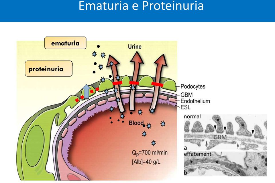 proteinuria