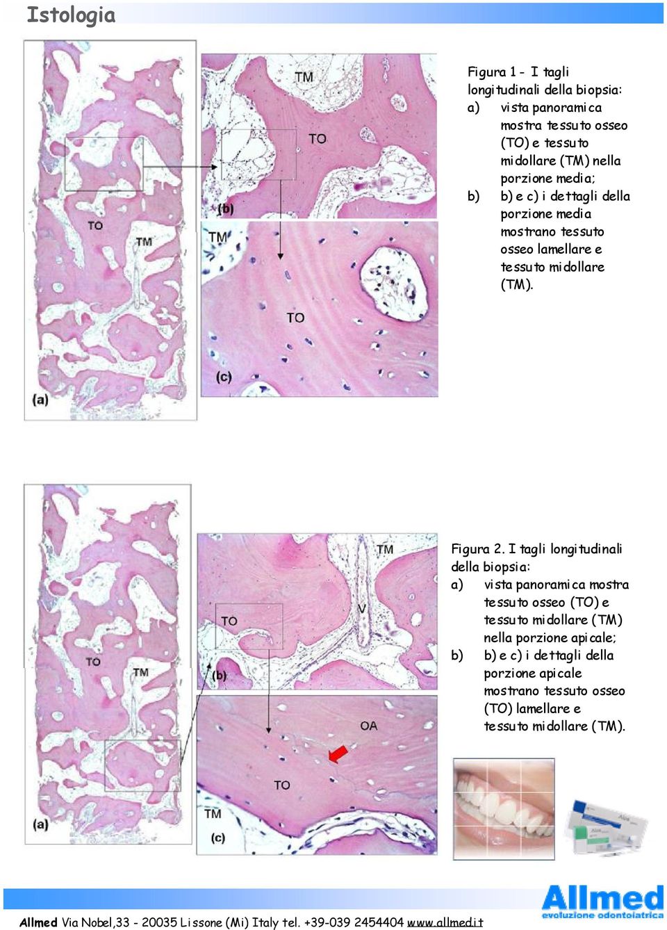 I tagli longitudinali della biopsia: a) vista panoramica mostra tessuto osseo (TO) e tessuto midollare (TM) nella porzione apicale; b) b) e c) i