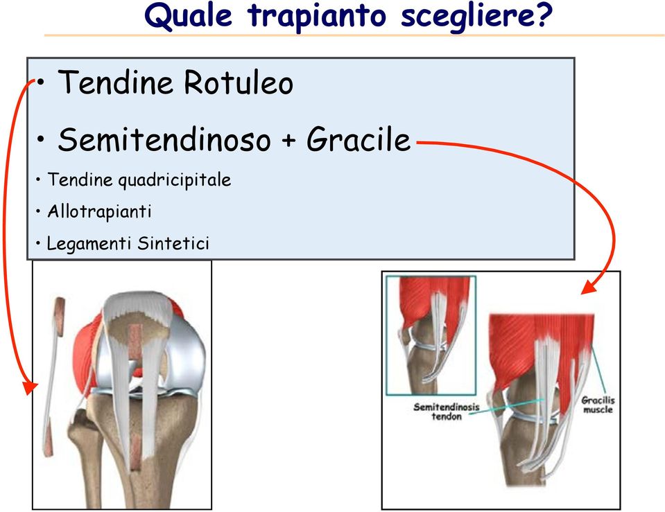 Semitendinoso + Gracile!