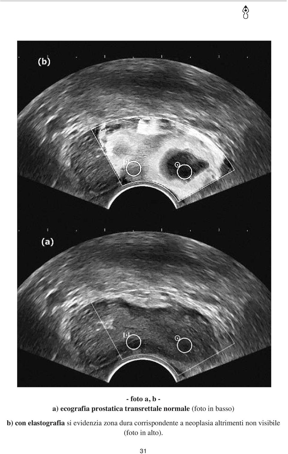 elastografia si evidenzia zona dura