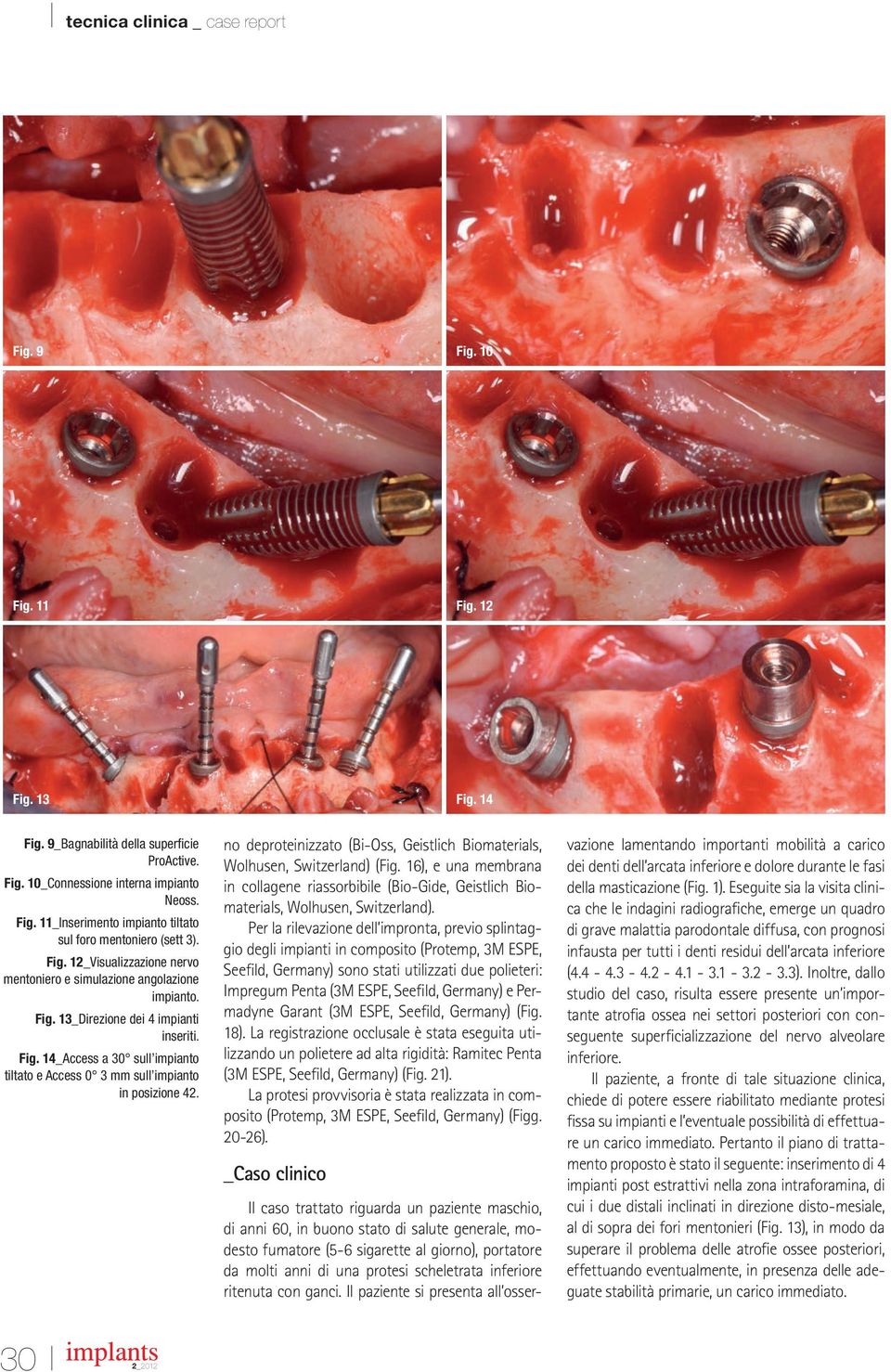 no deproteinizzato (Bi-Oss, Geistlich Biomaterials, Wolhusen, Switzerland) (Fig. 16), e una membrana in collagene riassorbibile (Bio-Gide, Geistlich Biomaterials, Wolhusen, Switzerland).