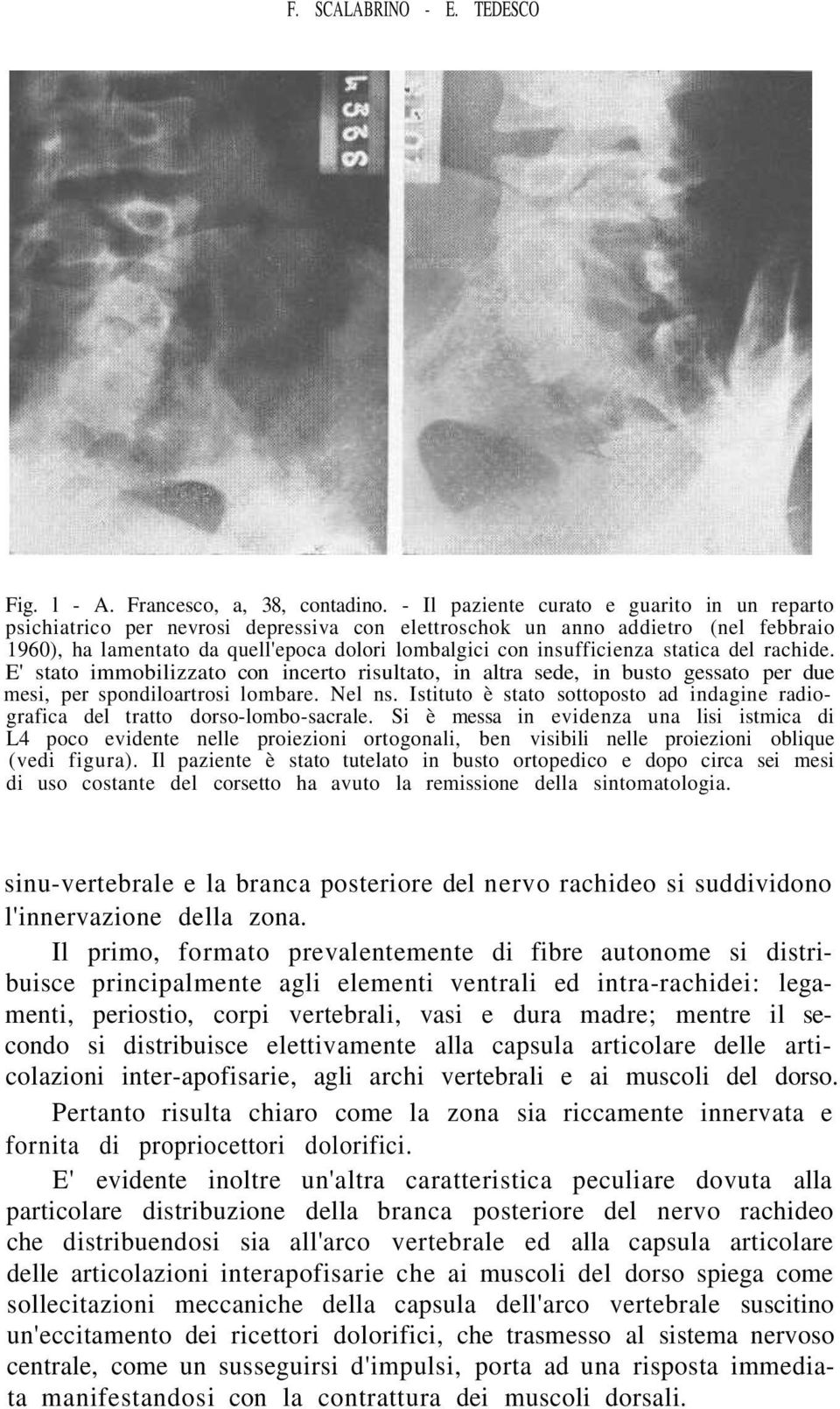 statica del rachide. E' stato immobilizzato con incerto risultato, in altra sede, in busto gessato per due mesi, per spondiloartrosi lombare. Nel ns.