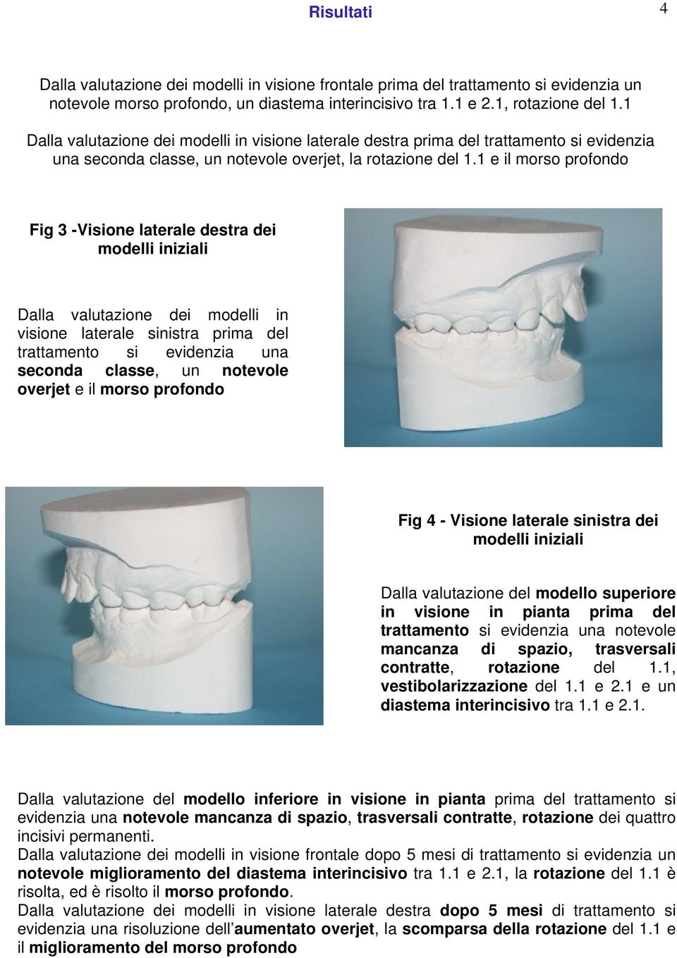 1 e il morso profondo Fig 3 -Visione laterale destra dei modelli iniziali Dalla valutazione dei modelli in visione laterale sinistra prima del trattamento si evidenzia una seconda classe, un notevole