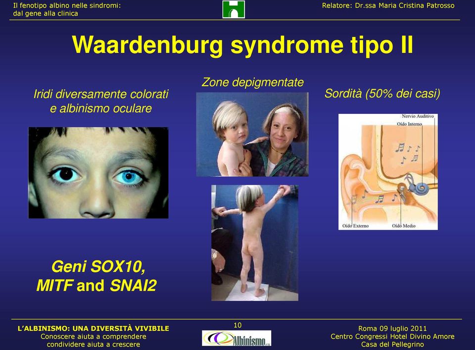 oculare Zone depigmentate Sordità