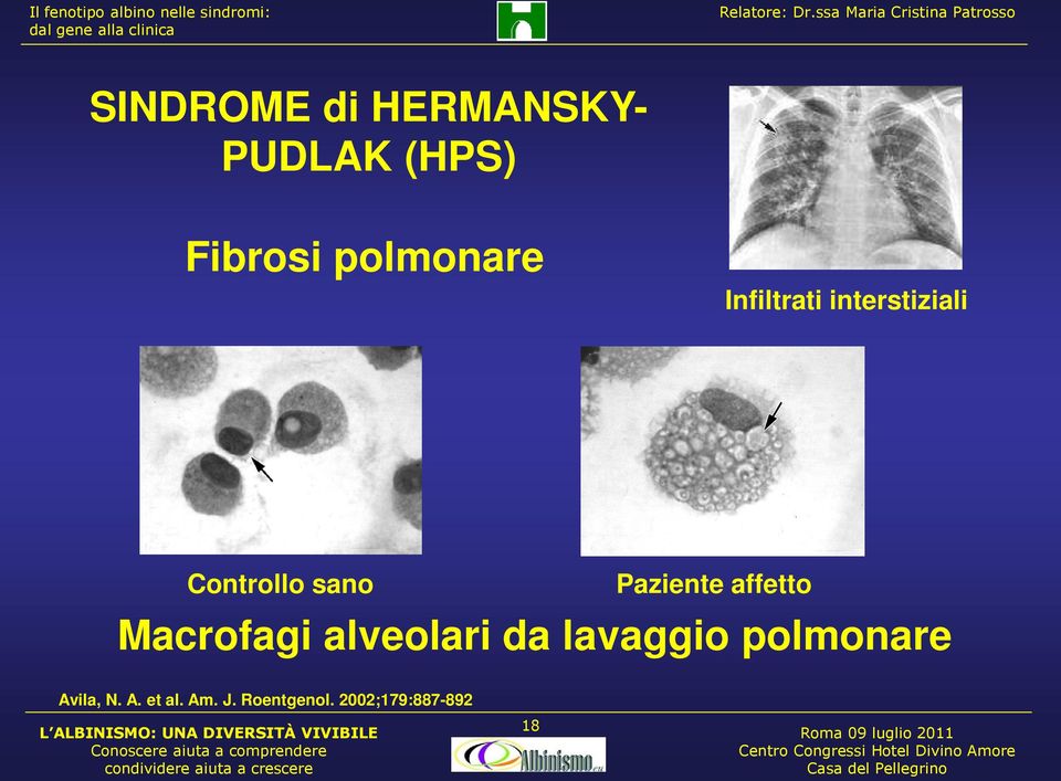 Paziente affetto Macrofagi alveolari da lavaggio