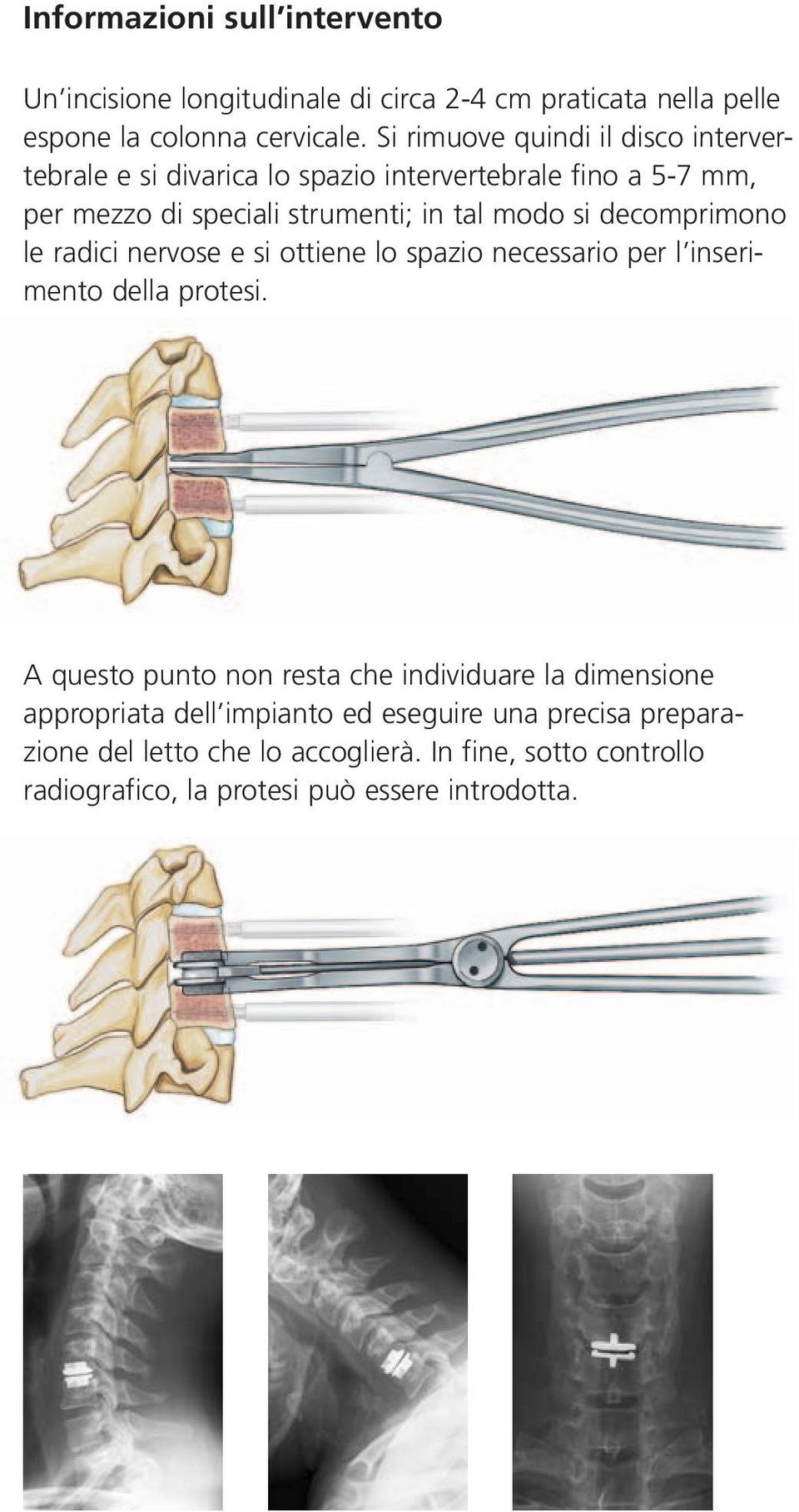 decomprimono le radici nervose e si ottiene lo spazio necessario per l inserimento della protesi.