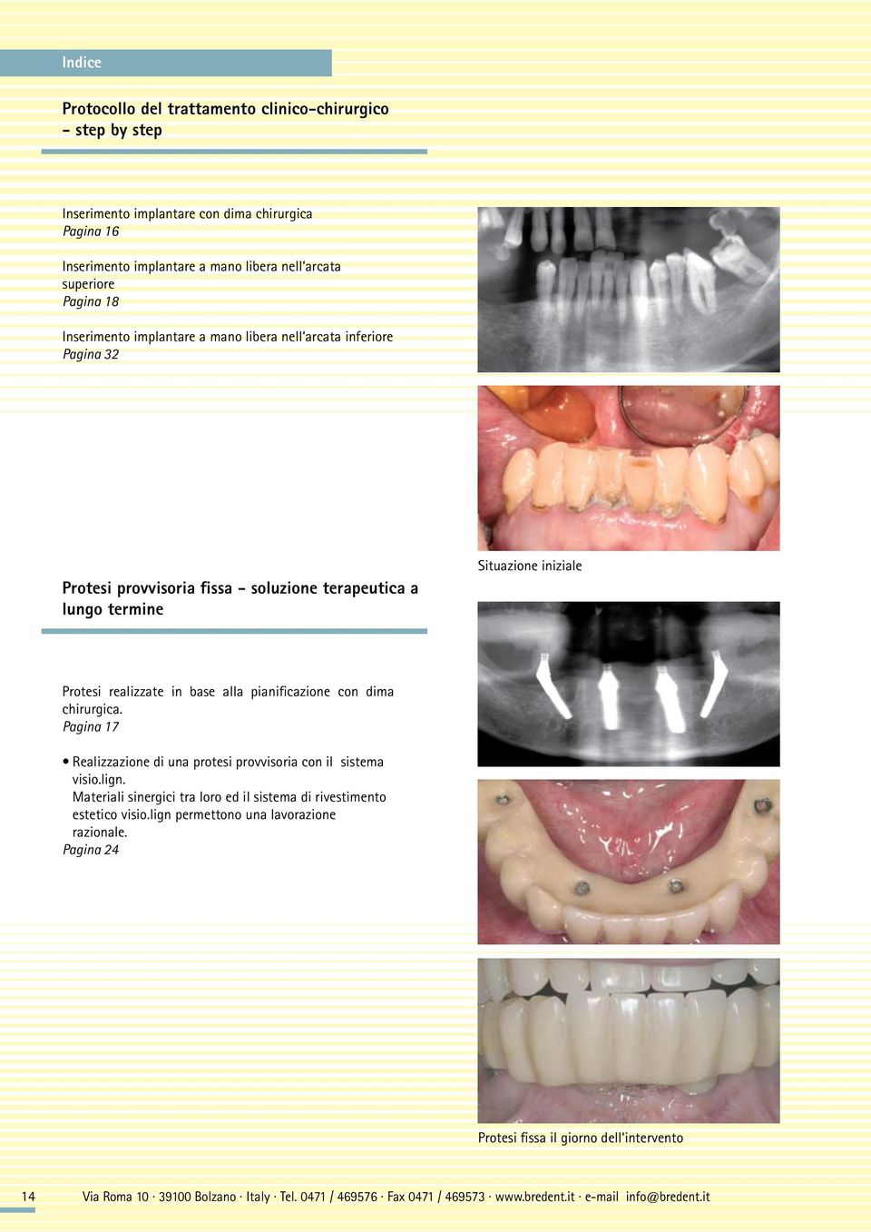 pianificazione con dima chirurgica. Pagina 17 Realizzazione di una protesi provvisoria con il sistema visio.lign. Materiali sinergici tra loro ed il sistema di rivestimento estetico visio.