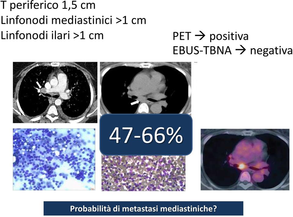 cm PET positiva EBUS-TBNA negativa