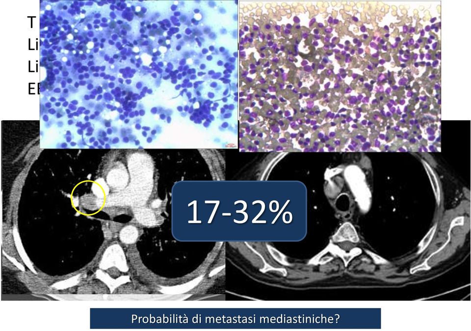 ilari >1 cm EBUS-TBNA negativa