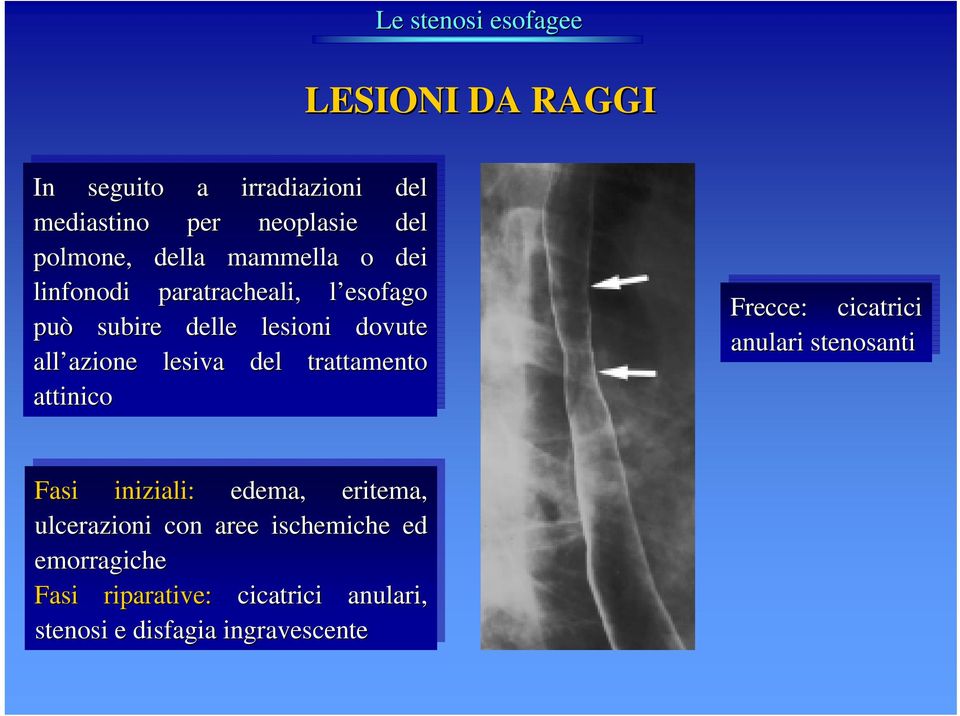 lesiva del del trattamento attinico Frecce: cicatrici anulari stenosanti Fasi Fasi iniziali: edema, eritema,