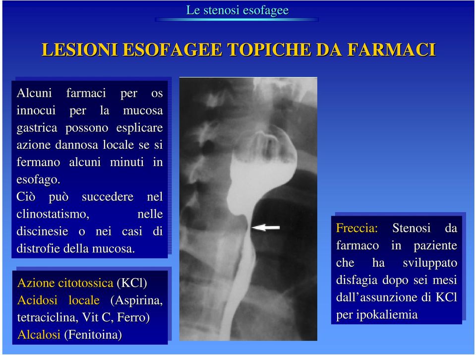 Ciò Ciò può può succedere nel nel clinostatismo,, nelle nelle discinesie o nei nei casi casi di di distrofie della della mucosa.