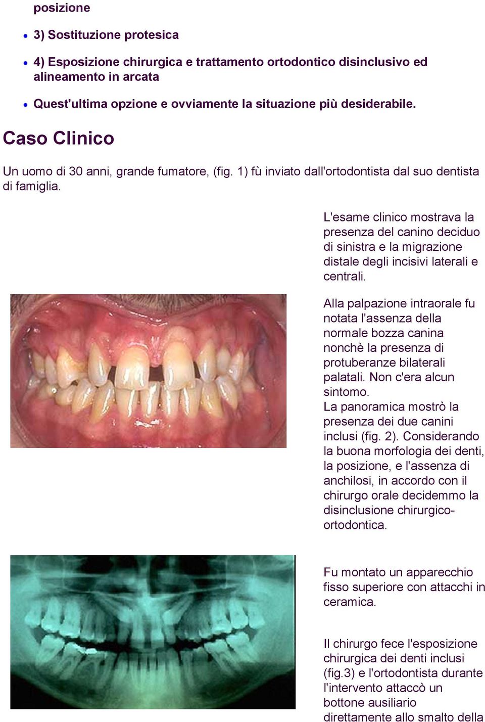 L'esame clinico mostrava la presenza del canino deciduo di sinistra e la migrazione distale degli incisivi laterali e centrali.