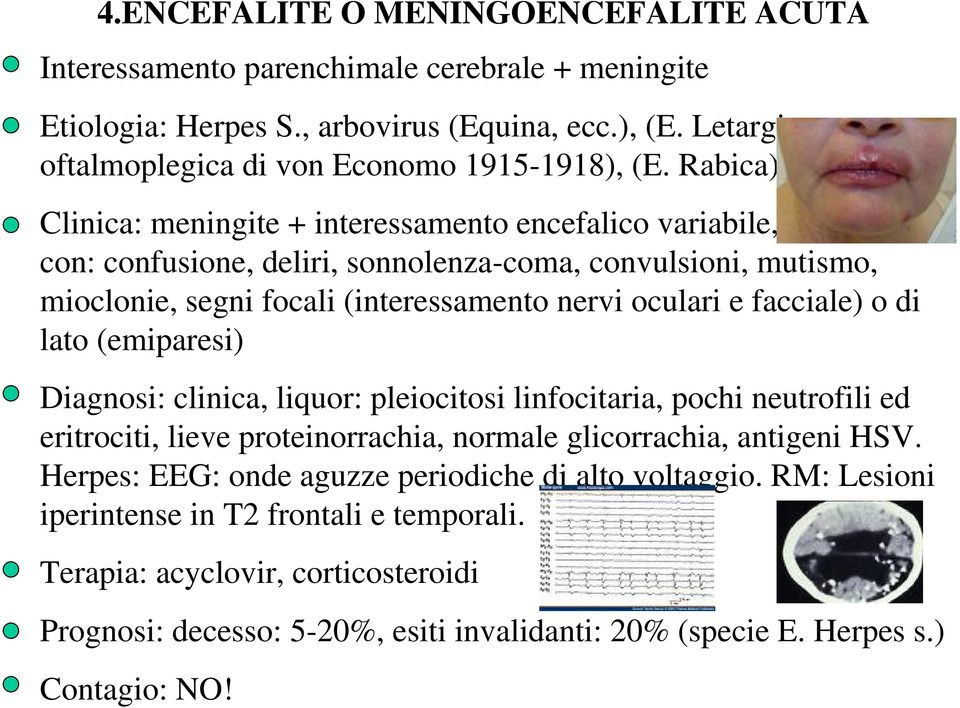 o di lato (emiparesi) Diagnosi: clinica, liquor: pleiocitosi linfocitaria, pochi neutrofili ed eritrociti, lieve proteinorrachia, normale glicorrachia, antigeni HSV.