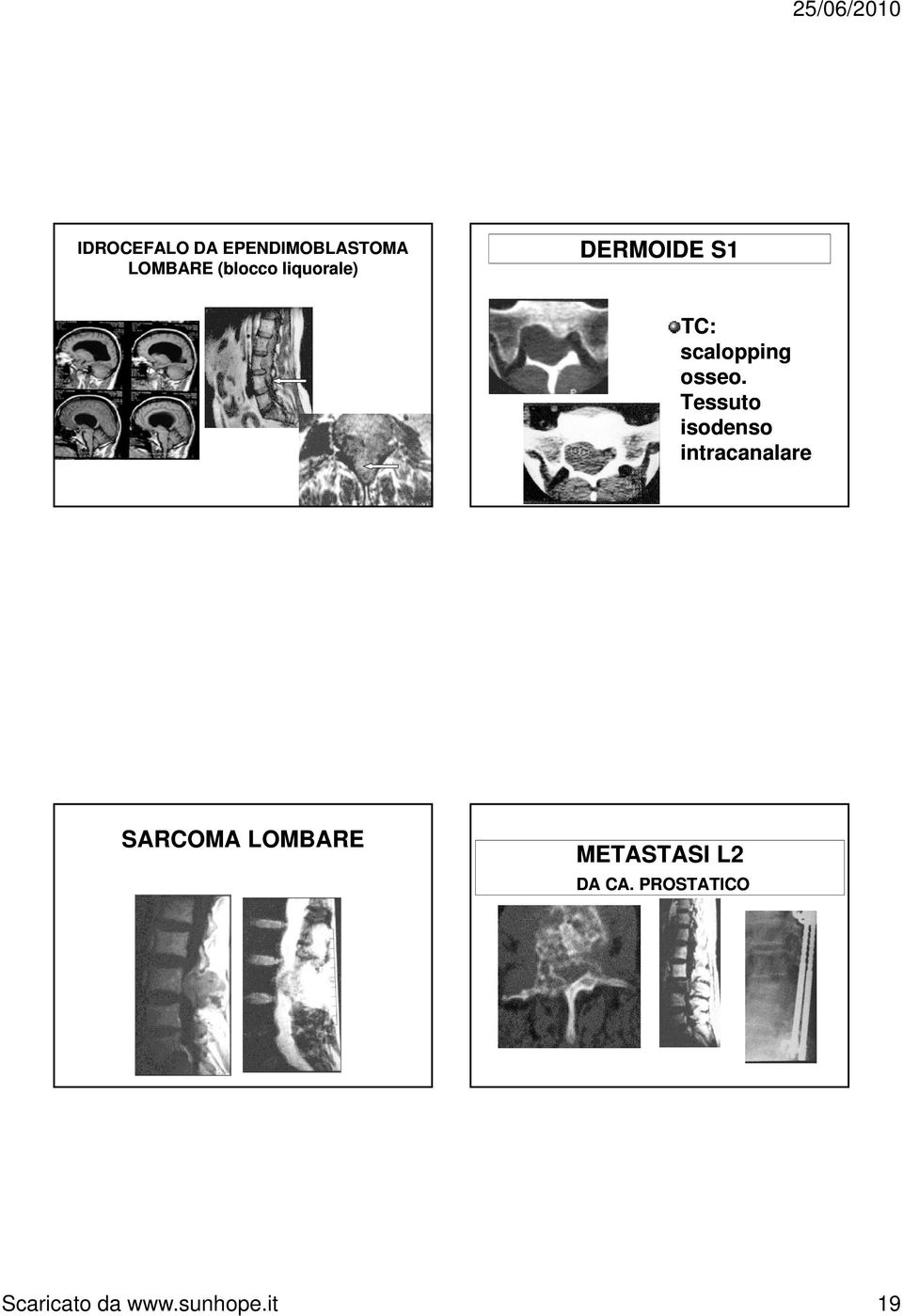 Tessuto isodenso intracanalare SARCOMA LOMBARE