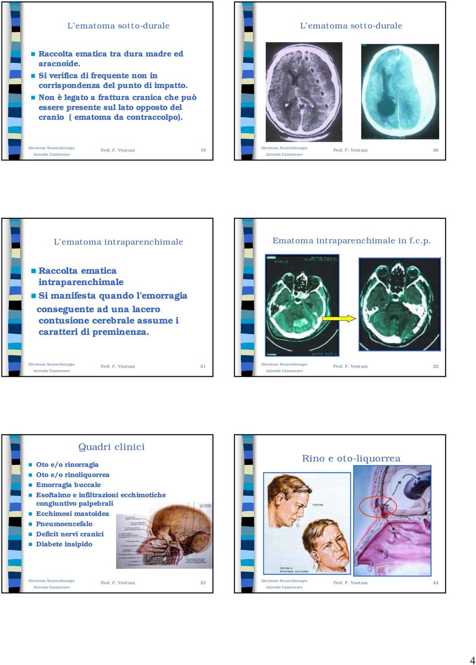 c.p. Raccolta ematica intraparenchimale Si manifesta quando l emorragia conseguente ad una lacero contusione cerebrale assume i caratteri di preminenza. Prof. F.