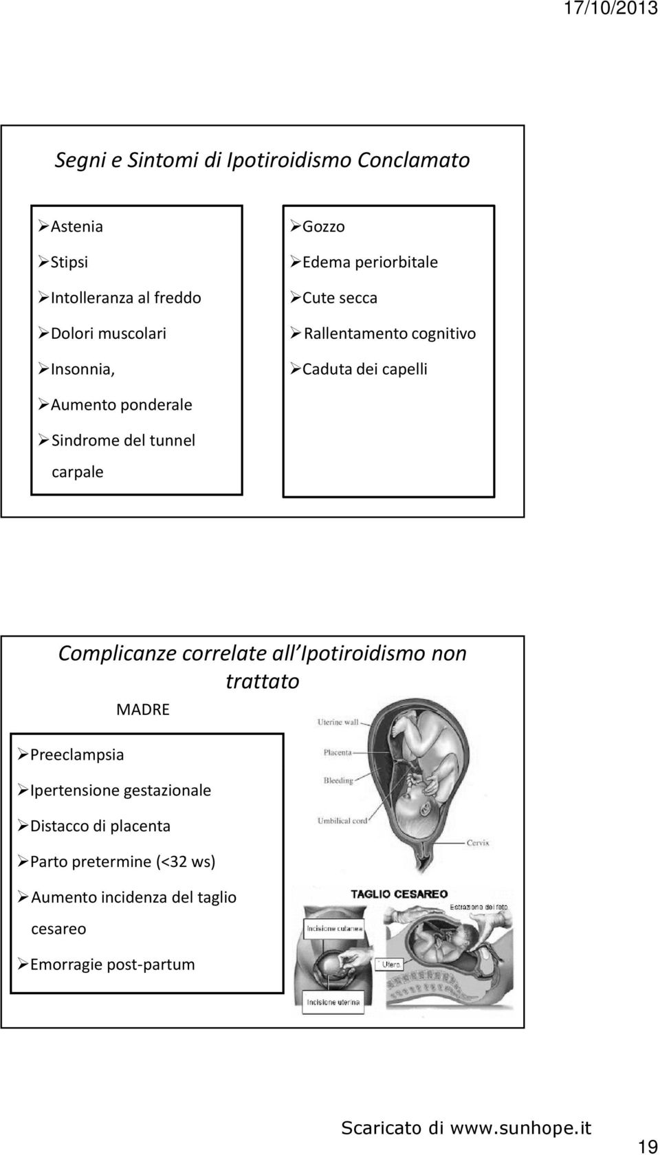 del tunnel carpale Complicanze correlate all Ipotiroidismo non trattato Preeclampsia MADRE Ipertensione