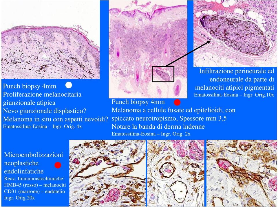 4x Infiltrazione perineurale ed endoneurale da parte di melanociti atipici pigmentati 10x Punch biopsy 4mm Melanoma a cellule fusate ed epitelioidi,