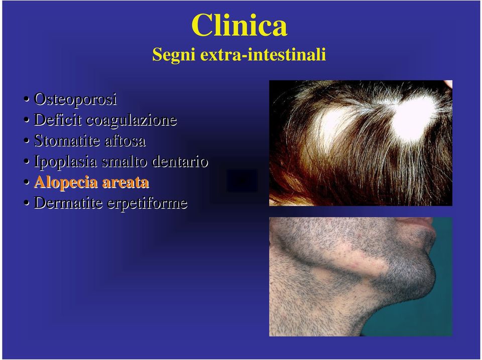 dentario Alopecia areata Dermatite