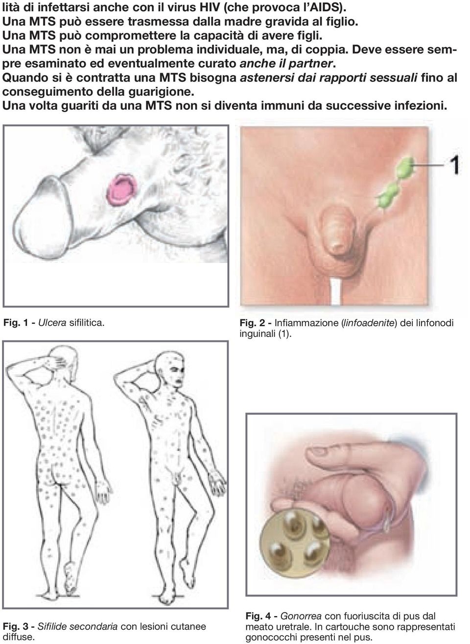 Quando si è contratta una MTS bisogna astenersi dai rapporti sessuali fino al conseguimento della guarigione. Una volta guariti da una MTS non si diventa immuni da successive infezioni. Fig.