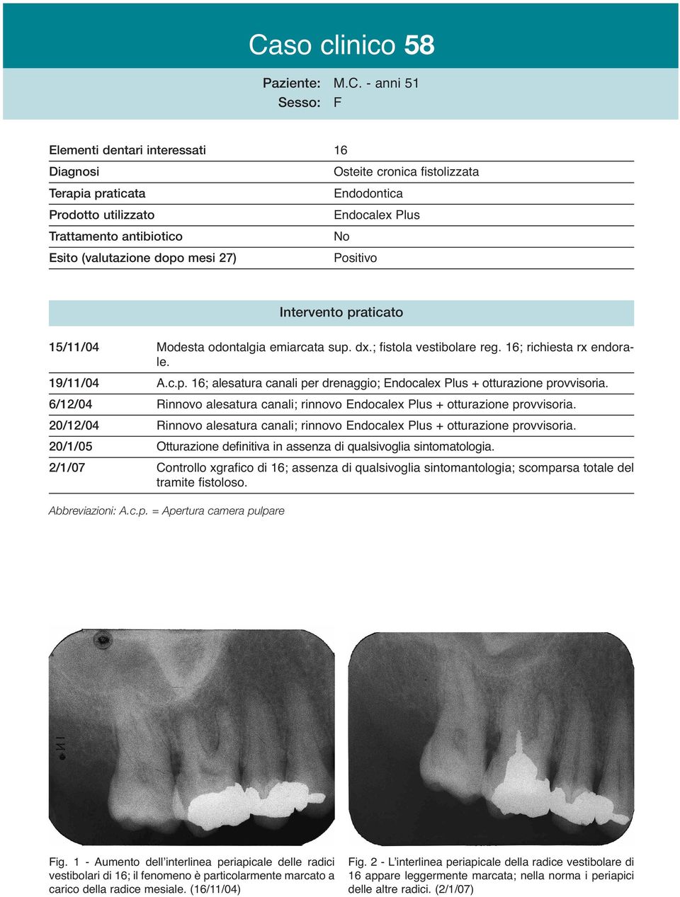 6/12/04 Rinnovo alesatura canali; rinnovo + otturazione provvisoria. 20/12/04 Rinnovo alesatura canali; rinnovo + otturazione provvisoria.