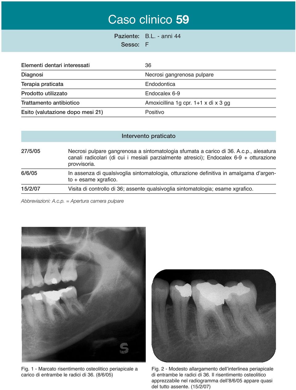 6/6/05 In assenza di qualsivoglia sintomatologia, otturazione definitiva in amalgama dʼargento + esame xgrafico. 15/2/07 Visita di controllo di 36; assente qualsivoglia sintomatologia; esame xgrafico.