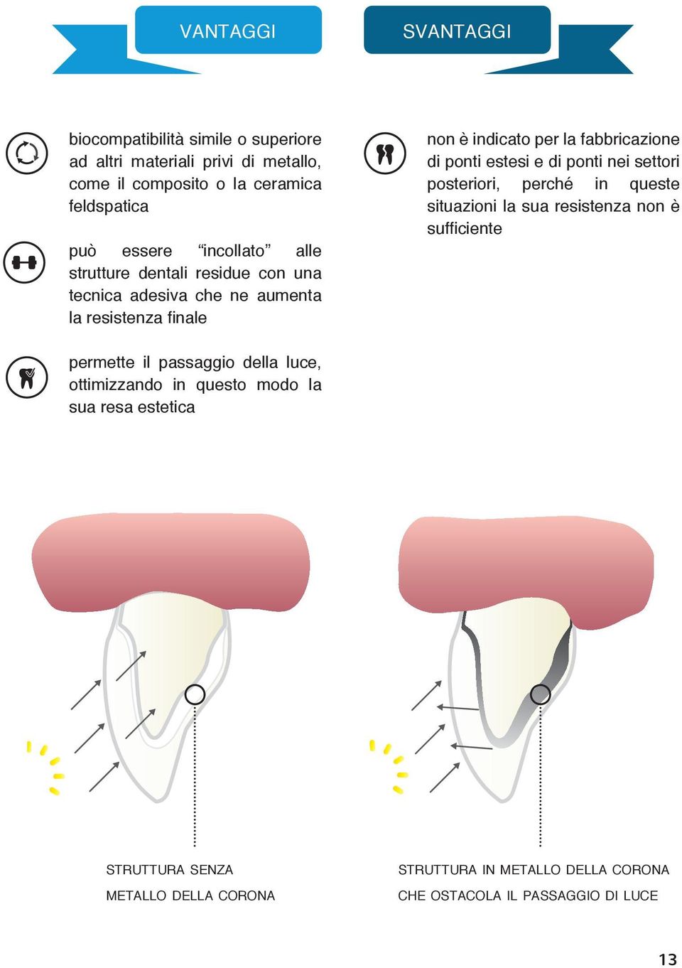 estesi e di ponti nei settori posteriori, perché in queste situazioni la sua resistenza non è sufficiente permette il passaggio della luce,