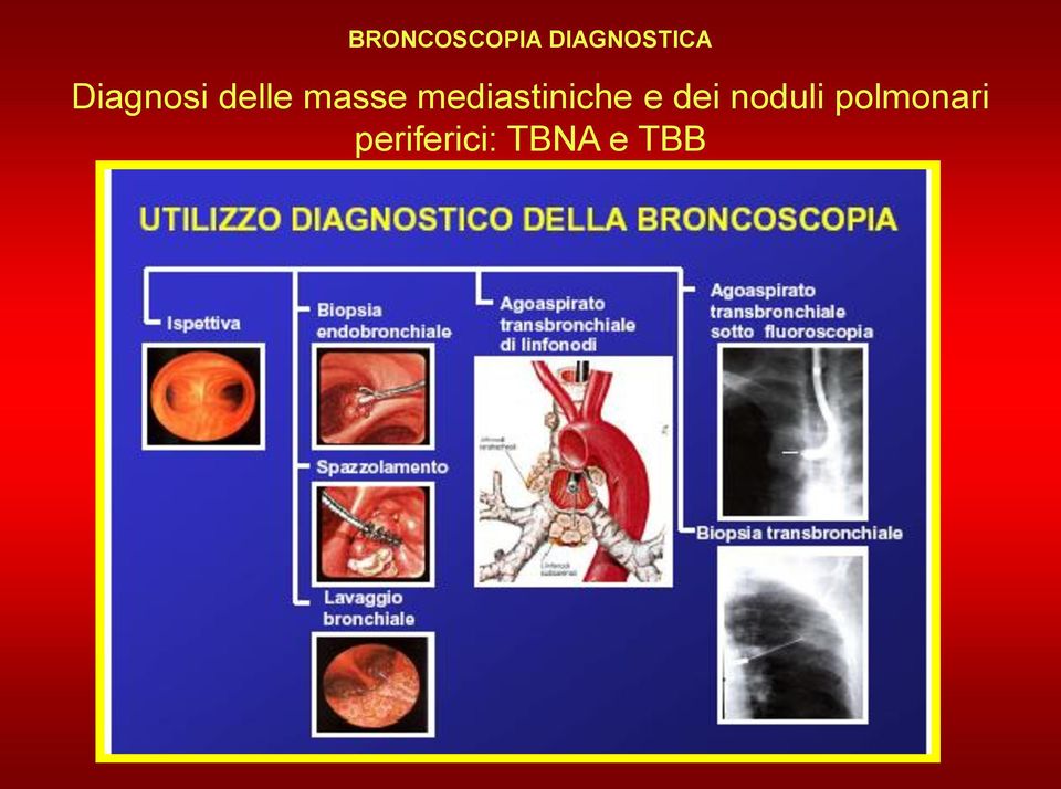 mediastiniche e dei noduli