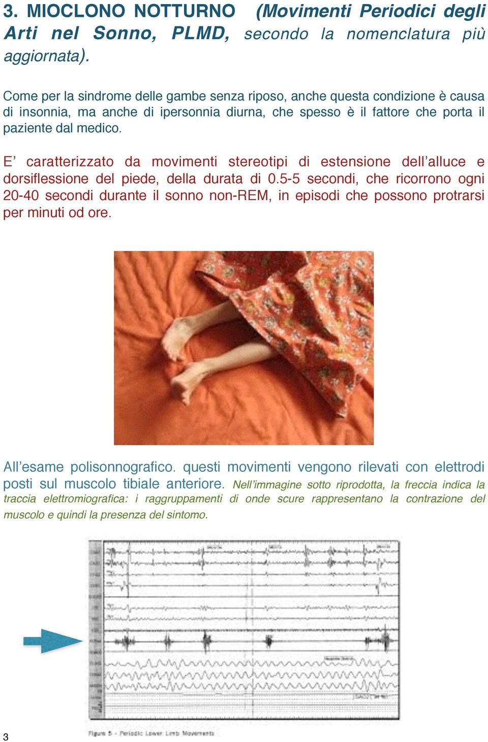 E caratterizzato da movimenti stereotipi di estensione dell alluce e dorsiflessione del piede, della durata di 0.