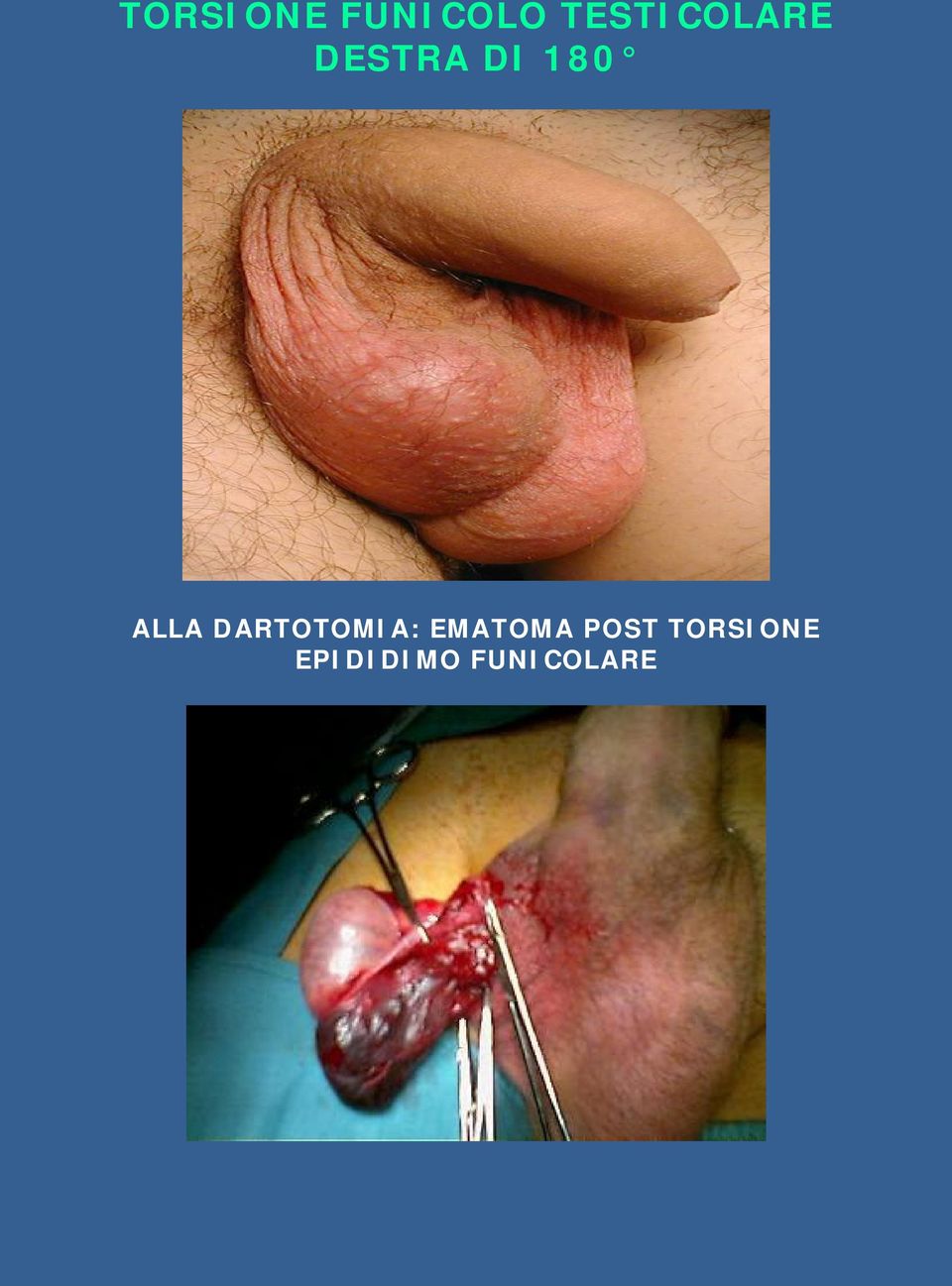 ALLA DARTOTOMIA: EMATOMA