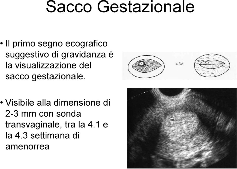 sacco gestazionale.